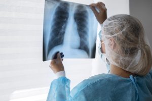 Sintomas, casuas y tratamientos para el cancer de pulmon